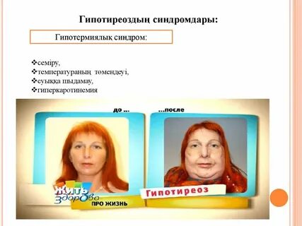 Гипотиреоз ноги