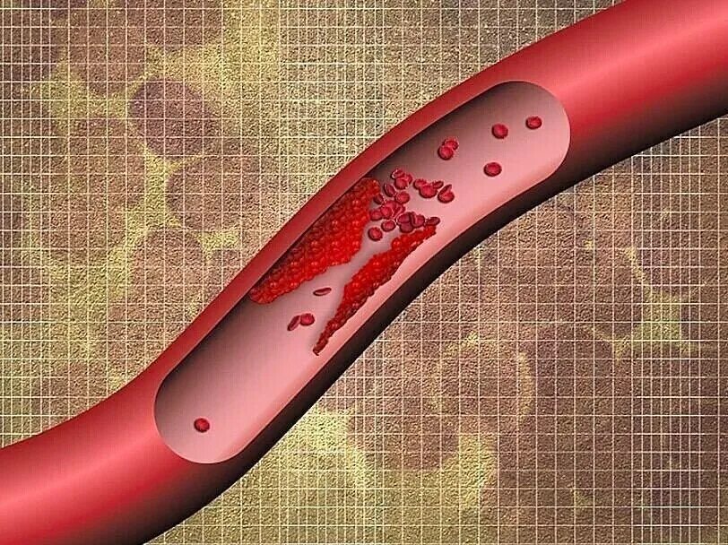 Тромбоз закупорка сосудов. Тромбоэмболия кровеносного сосуда. Микрососудистый тромбоз. Микротромбозы сосудов. Чем отличается тромб