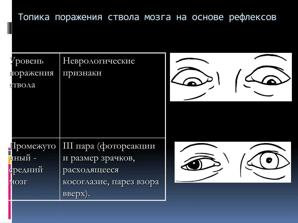 Уровни головного мозга. Поражение стволового мозга. Паралич горизонтального взора. Инсульт в стволе мозга симптоматика. Авм мальформация сосудов головного мозга.