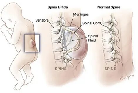 Spina