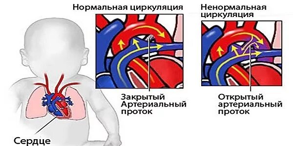 Не закрывается окно у новорожденных