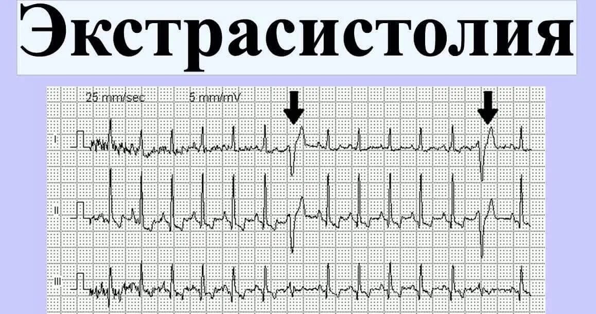 Аритмия и экстрасистолия на ЭКГ. ЭКГ нарушение ритма сердца экстрасистолия. Экстрасистолия ЭКГ диагностика. Экстрасистолическая аритмия на ЭКГ. Экстрасистолы много