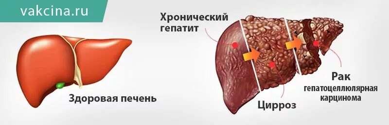 Гепатит hb. Осложнения при вирусном гепатите в. хронический гепатит цирроз.
