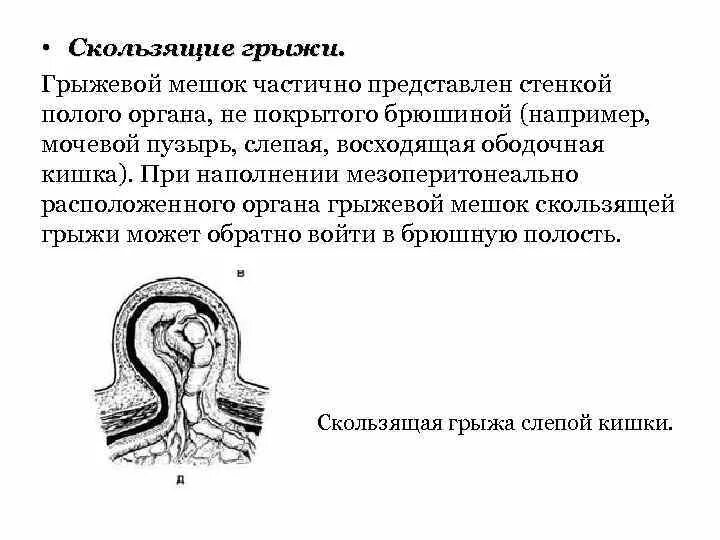 Скользящая грыжа под. Грыжевой мешок скользящей грыжи. Скользящая грыжа мочевого пузыря. Стенки скользящей грыжи.