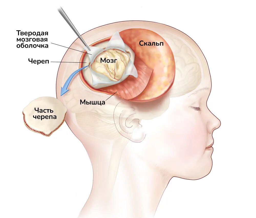 Трепанация черепа головного мозга. Краунотомия головного мозга. Опухоль мозга после операции. Проведенные на головном мозге