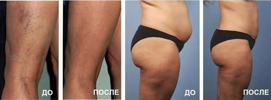 Прессотерапия от целлюлита отзывы. Липолитики уколы от целлюлита. Целлюлит до и после. Прессотерапия для похудения до после. Прессотерапия от целлюлита отзывы.