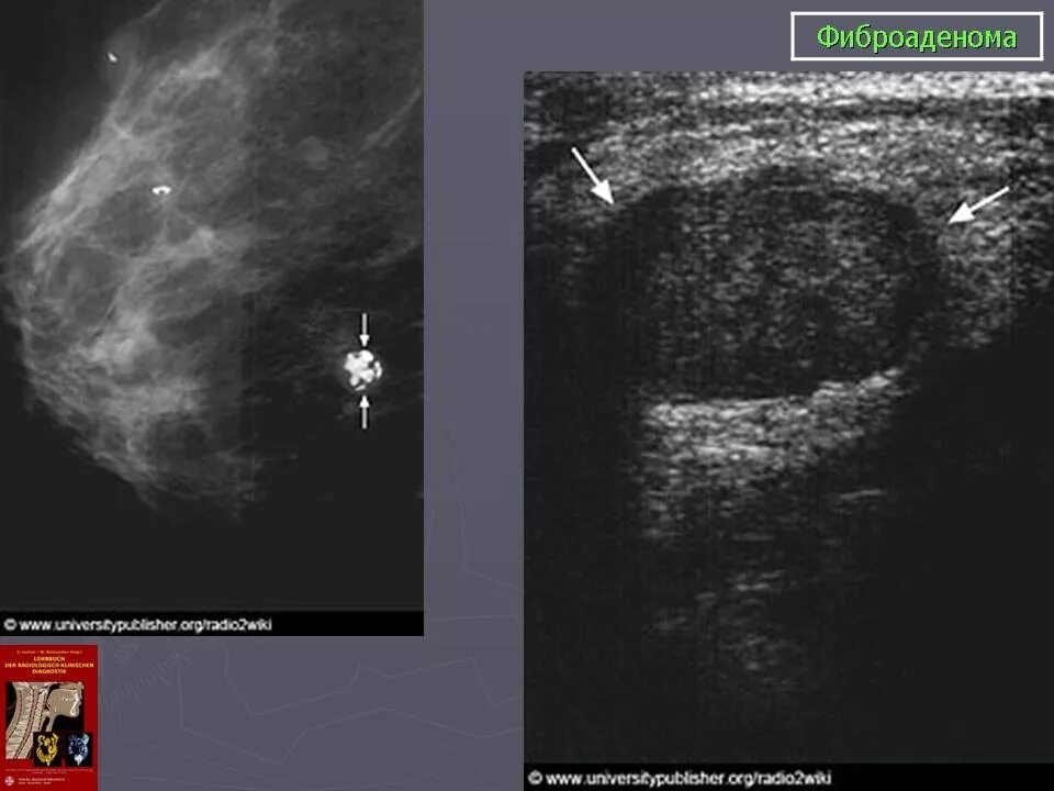 Фиброаденома мол жел УЗИ. Кисты и фиброаденомы молочной железы. Фиброаденоматоз молочной железы на УЗИ. УЗИ снимки фиброаденомы молочной железы.