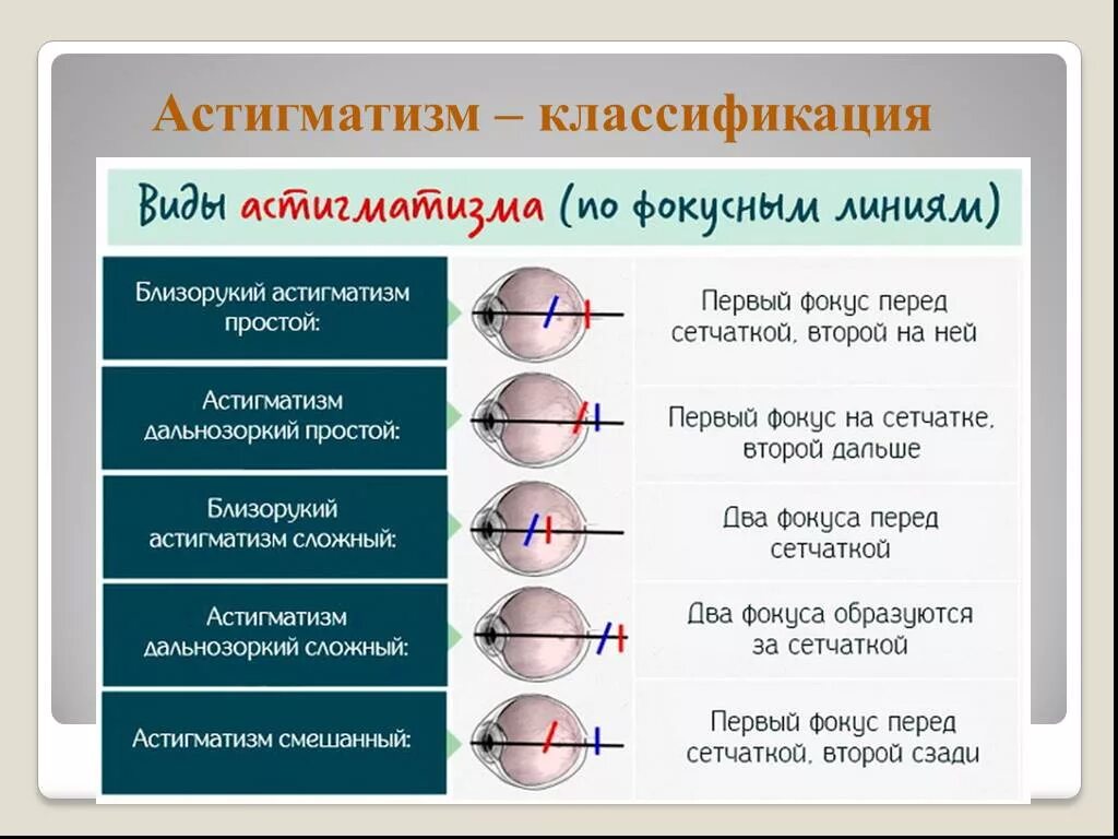 Что такое сложный миопический астигматизм. Миопический астигматизм классификация. Миопия 2 степени сложный миопический астигматизм. Прямой смешанный астигматизм 1 степени. Миопический астигматизм что это такое простыми словами.