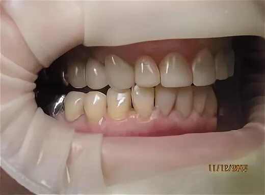 Клыковый