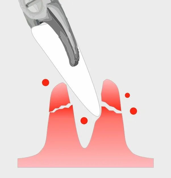 Почему кровь из зубов. Альвеолит зубной лунки.