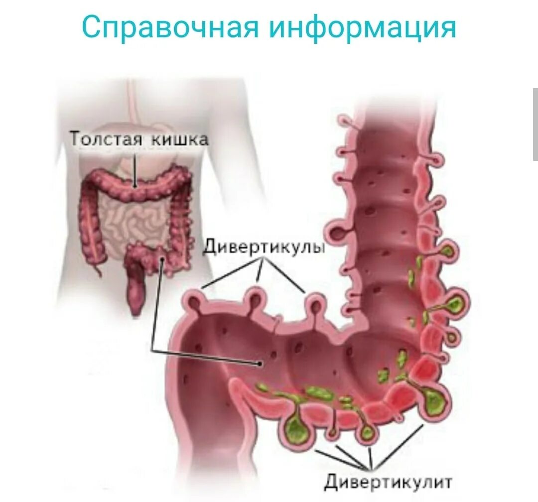 Врач лечит кишки. Дивертикулёз сигмовидной кишки. Дивертикулы сигмовидной кишки. Дивертикулы толстой кишки колоноскопия. Дивертикулярная болезнь и дивертикулит.