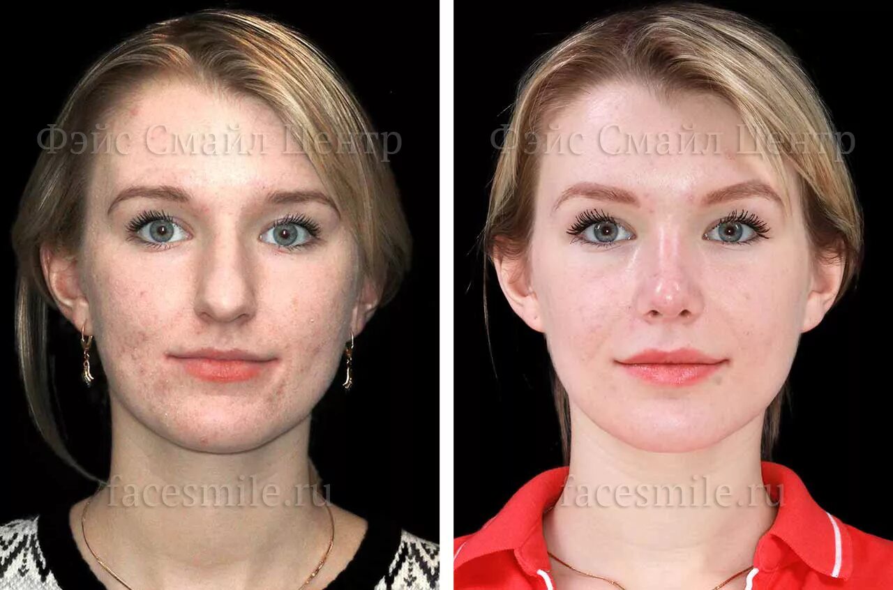 Глубокий прикус до и после в профиль. Металлические брекеты на кривых зубах. Исправление 23. Дистальный перекрестный прикус. Глубокий прикус профиль.