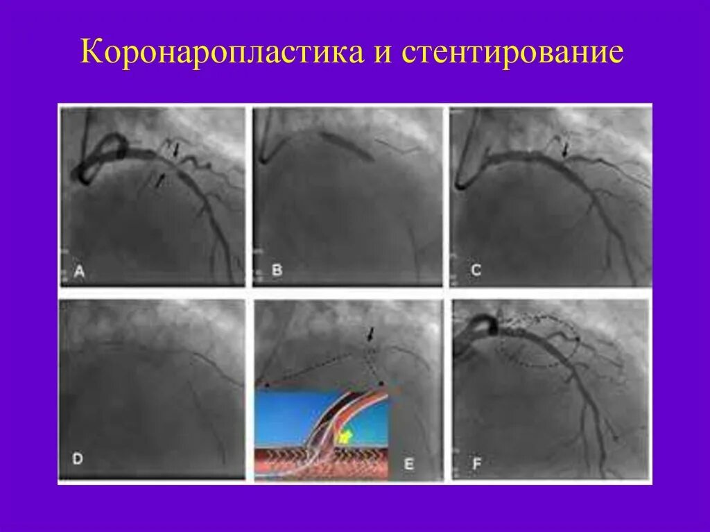 Стентирование коронарных артерий. Бифуркационное стентирование коронарных артерий. Стентирование бифуркационных поражений коронарных артерий. Техники бифуркационного стентирования. Стентирование прогнозы
