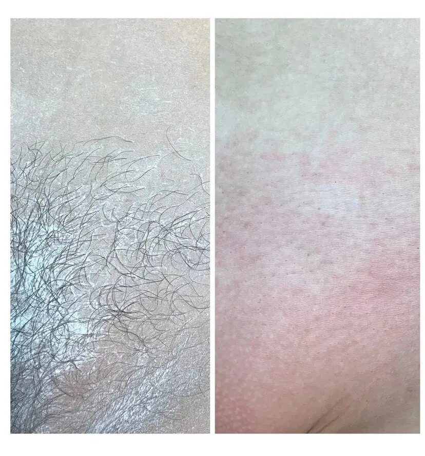 Депиляция зоны бикини. Эпиляция зоны глубокого бикини. Шугаринг бикини до и после. Лазерная депиляция зоны глубокого бикини. Шугаринг бикини до и после.