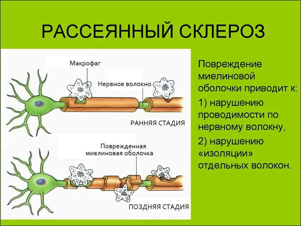 Рассеянный склероз как проявляется у женщин. Повреждение миелиновой оболочки болезнь. поврежденные миелиновые оболочки нервных волокон. миелиновая оболочка мультиполярного нейрона. миелиновое нервное волокно рассеянный склероз.