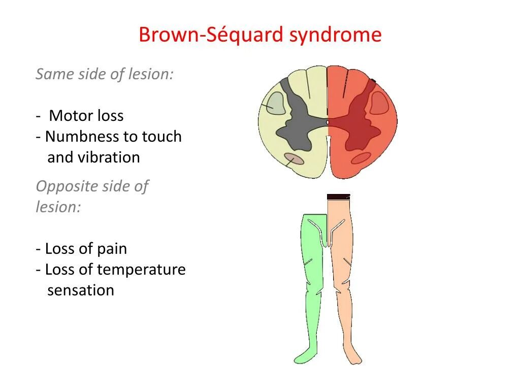 Same side. Mononeuropathy. Brown Sequard Sendromu. Brown Sequard Syndrome Rehabilitation.