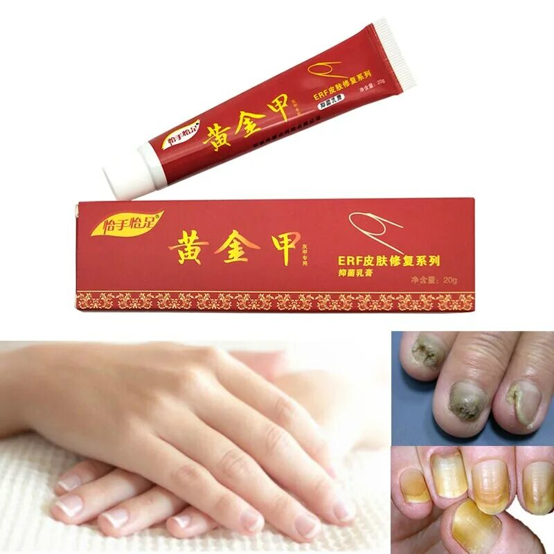 Китайский крем от грибка ногтей Nail fungus. Китайское средство от грибка fungal Nail treatment. Китайская мазь для ногтей. Китайское средство от псориаза ногтей. Ногтевой крем