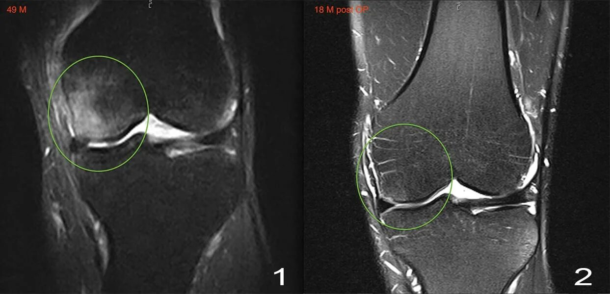 Повреждение коленного сустава 3 степени. Разрыв медиального мениска коленного сустава рентген. Мрт разрыв заднего рога мениска. Разрыв медиального мениска коленного сустава мрт. Дискоидный мениск сустава.
