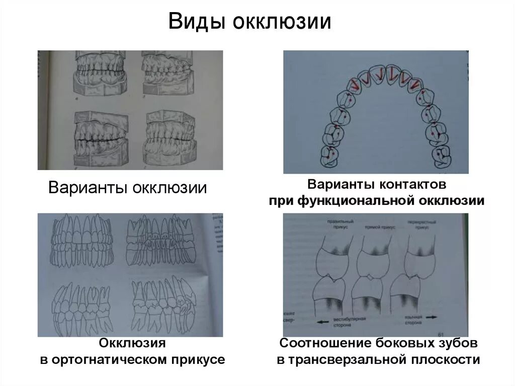 Что значит окклюзия. Артикуляция окклюзия и прикус зубов. окклюзия и артикуляция в стоматологии. понятия окклюзия, артикуляция, прикус.. прикус и окклюзионные контакты зубов.