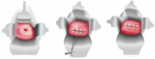 Истмико-цервикальная недостаточность. Операции при истмико цервикальной недостаточности. Швы при ицн