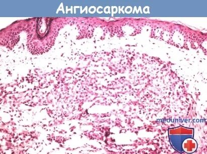 Ангиосаркома кожи как выглядит Propranolol in Angiosarcoma: First Major Advance in Decades