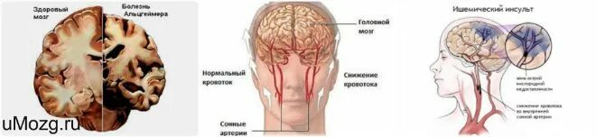 Мр признаки очагового изменения