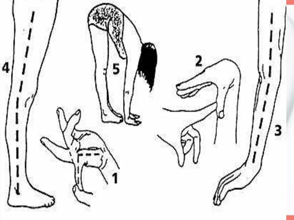 Гипермобольность мустава. Дисплазия соединительной ткани и гипермобильность суставов. Марфана гипермобильность суставов. Дисплазия соединительной ткани марфана. Марфана гипермобильность суставов.