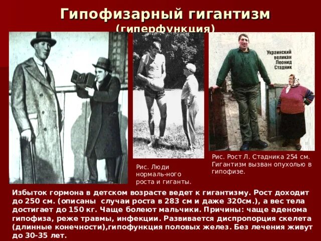 Гигантизм на алтае встречается не только. Карликовость гигантизм акромегалия. клинические проявления гигантизма. соматотропный гормон гигантизм. гипофункция гигантизм.