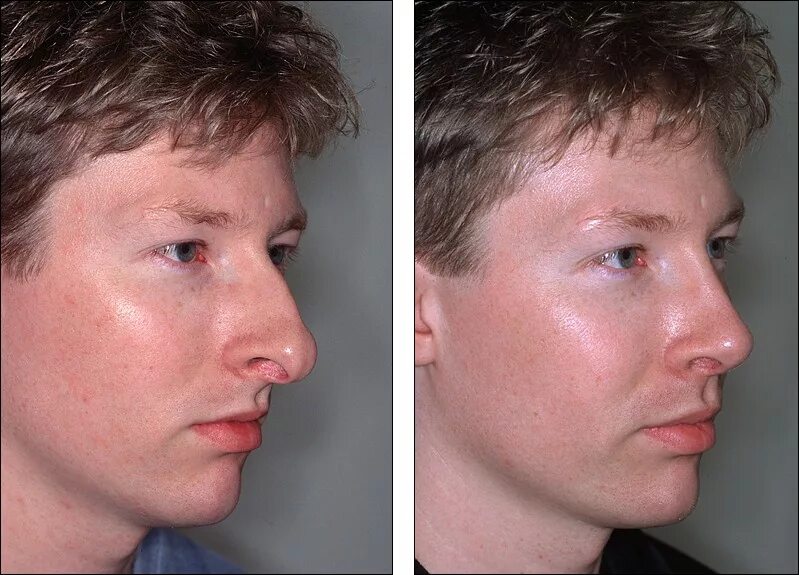 Что такое ринопластика лица. Ринопластика. Эми адамс ринопластика. Кдаления гарбинки на нос. Пластика носа.