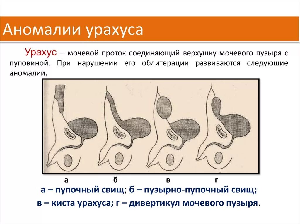 Аномалия мочевого протока урахуса. Урахус гистология строение. Врождённая патология урахуса. Операция мочевой пузырь собака