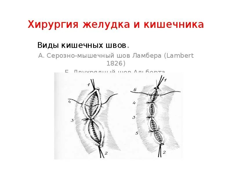 Операция желудка кишечника. Шов Ламбера кишечный. Виды кишечных швов. Хирургические швы кишечные.