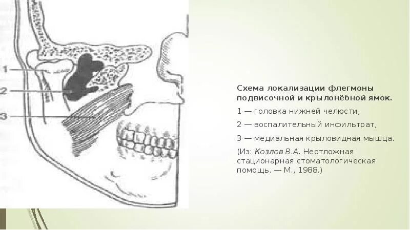 Абсцесс челюстного пространства. Флегмона подвисочной и крылонебной областей. разрезы в подвисочной флегмоне. флегмона крыловидно небного пространства.