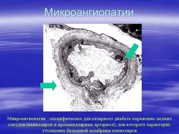Микроангиопатия что это значит. Микроангиопатия сахарный диабет. диабетическая микроангиопатия патогенез. патогенез диабетической ангиопатии.