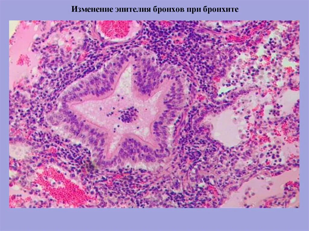 Реактивные изменения метаплазированных клеток. Метаплазия гистология. Слизистая дистрофия эпителия бронха. Препарат метаплазия эпителия бронхов. Гиперплазия эпителия бронхов.