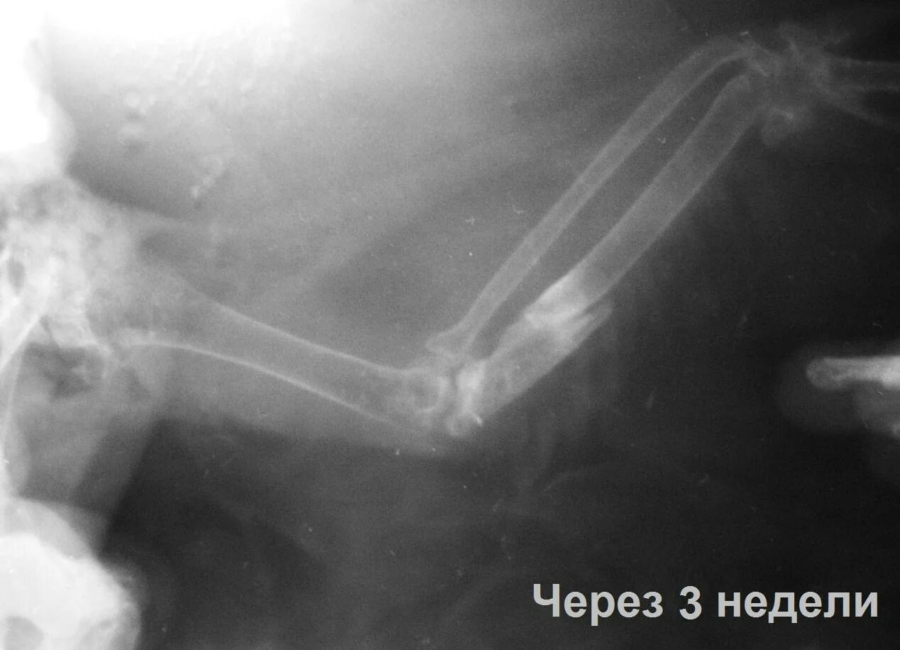 Перелом через 3 недели. Перелом через 3 недели. Перелом берцовая кость кости. Костная мозоль после перелома на рентгене. Перелом малоберцовой кости остеосинтез.