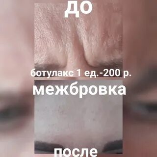 Ботулакс или диспорт