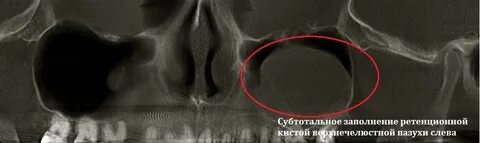 Киста правого верхней челюстной пазухи
