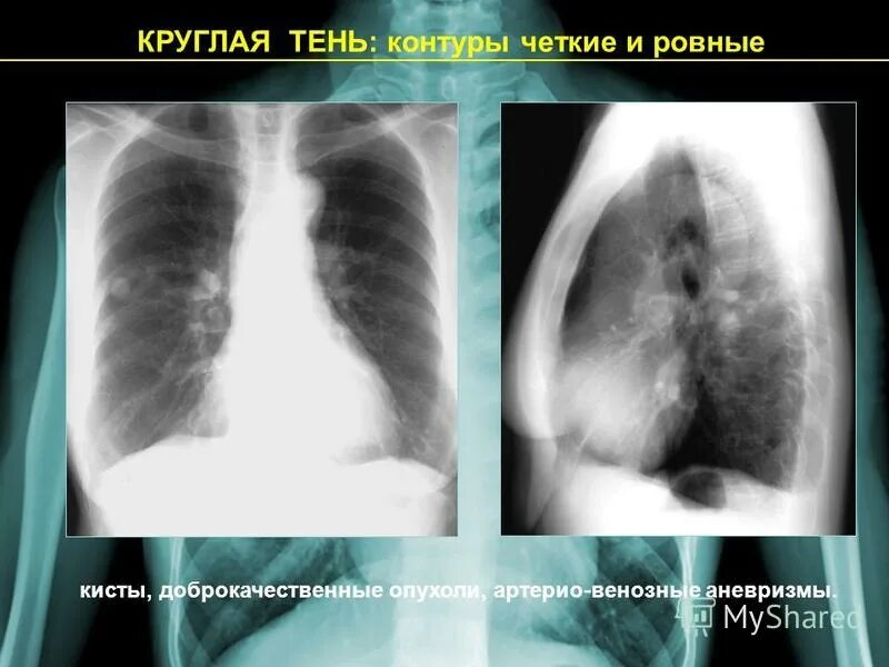 Область неоплазии в легком. Неоперабельная опухоль легкого. Симптомы онкологических заболеваний легких. Опухоль в легком 200 мм. Неоперабельная опухоль легкого.