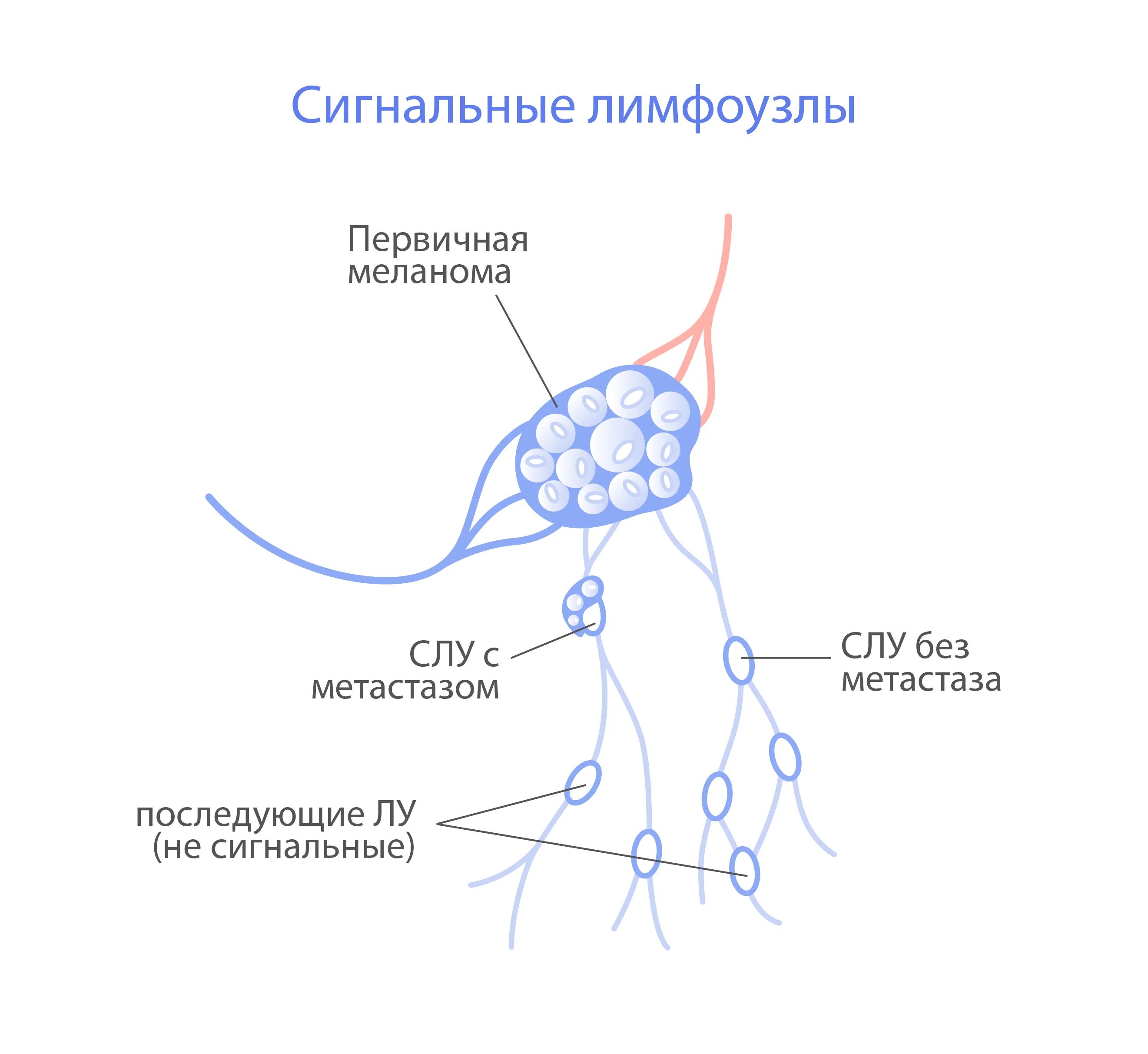 Какой лимфоузел при раке молочной железы
