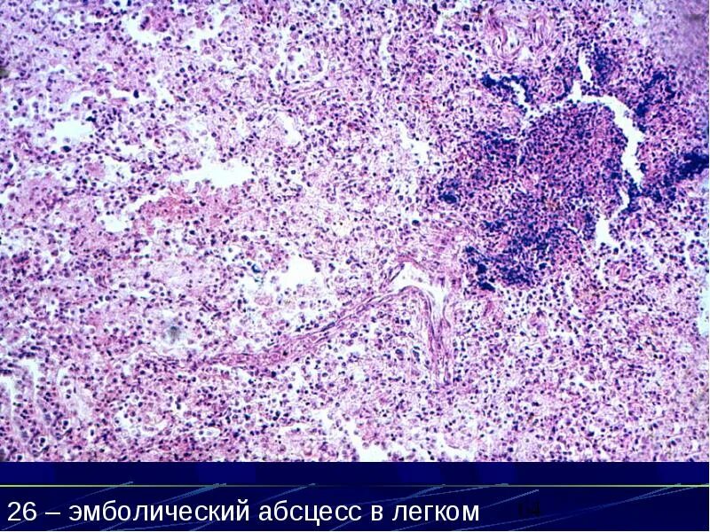 Эмболический Гнойный нефрит патанатомия. Метастатический абсцесс легкого микропрепарат. Эмболический абсцесс почки микропрепарат. Эмболический абсцесс легкого микропрепарат. Пиелонефрит микропрепарат