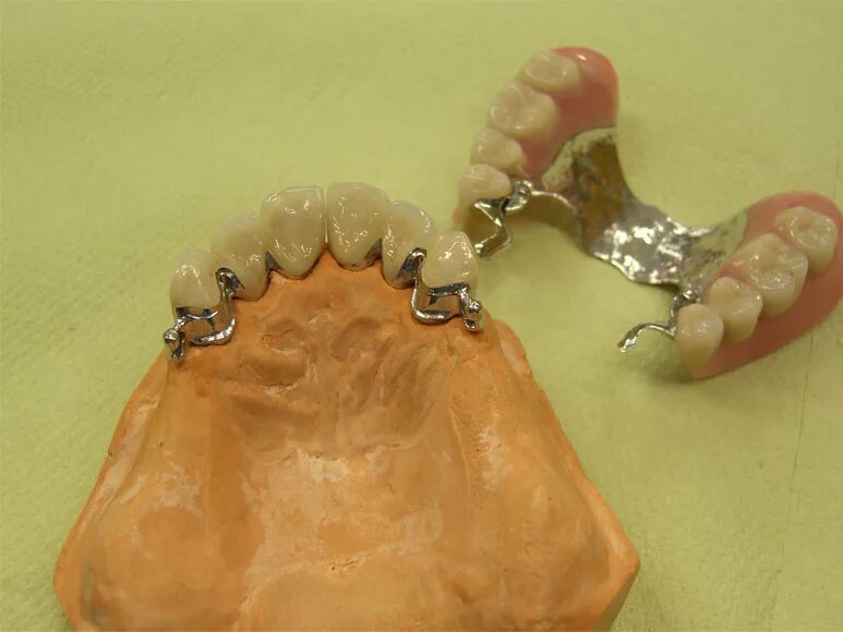 бюгельный протез на верхнюю челюсть. бюгельный протез (1 челюсть)+кламмер. бюгельный протез на кламмерах. снятие бюгельных протезов. бюгельный протез дентал-ди (a16.