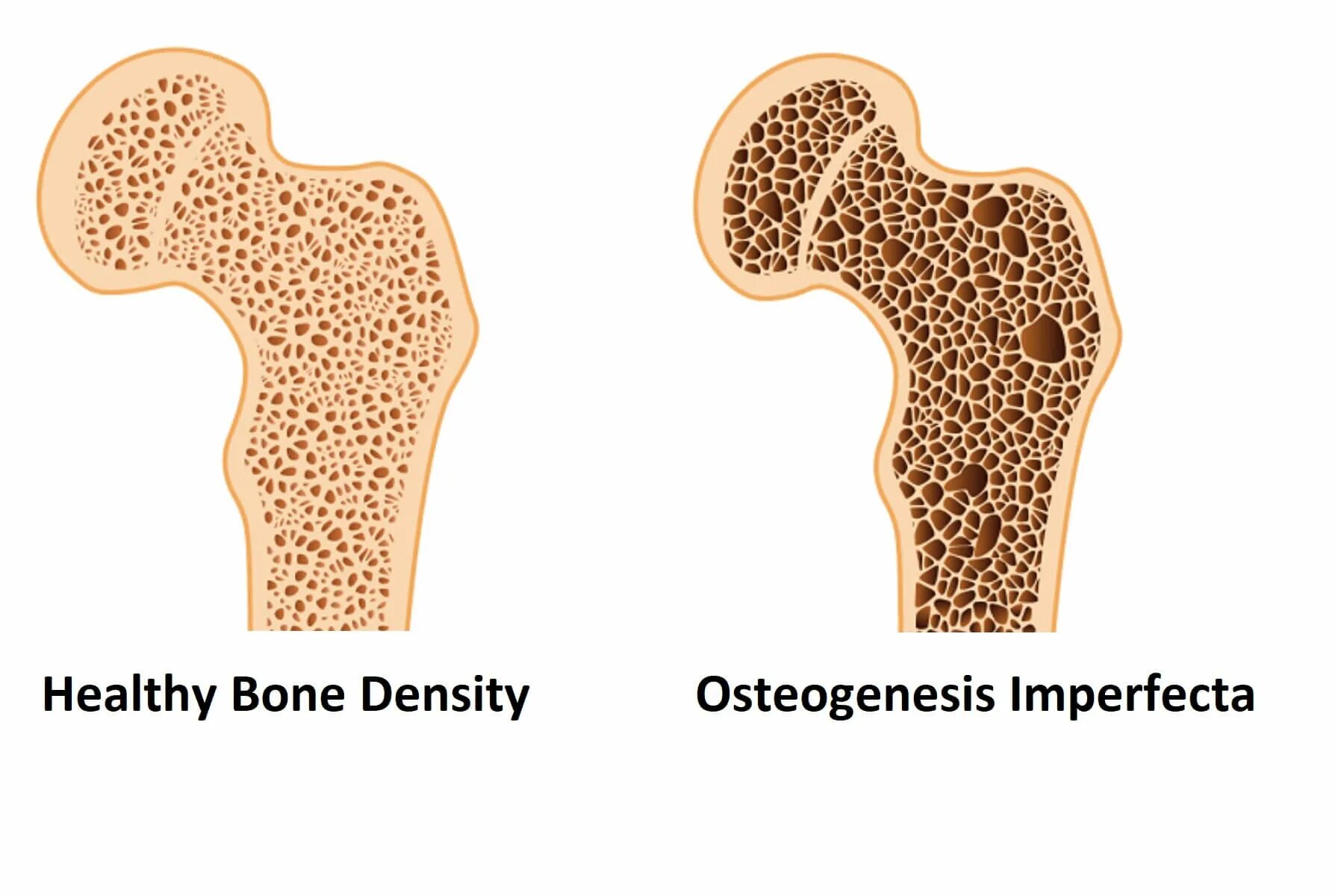 Остеопороз. Остеопоротические переломы. Детский остеопороз. Ломкие кости. Al bone