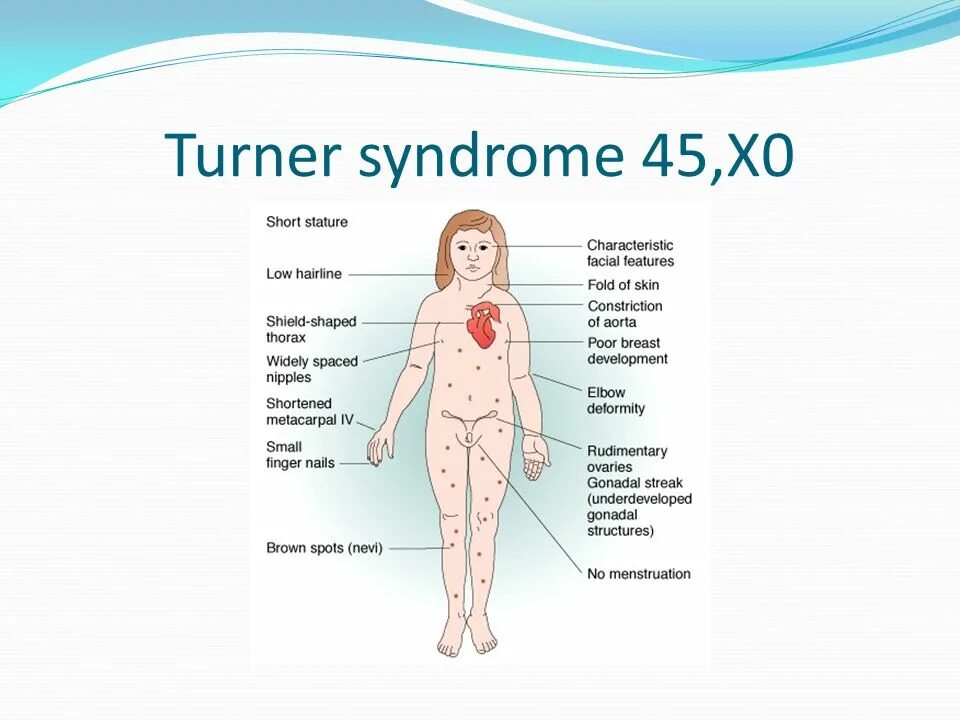 Синдром шерешевского тернера. Шерешевского тернера фото. Синдром шерешевского тернера. Синдром шерешевского тернера симптомы. Май тернера.