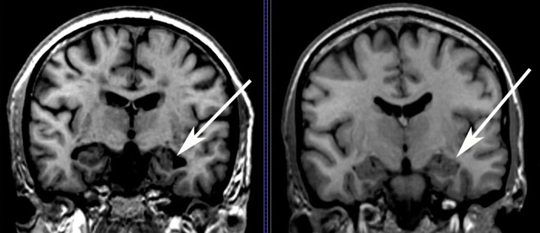Атрофия головного мозга продолжительность. Болезнь Альцгеймера снимки мрт. Мрт головного мозга болезнь Альцгеймера. Атрофия гиппокампа на мрт. Деменция на мрт головного мозга.
