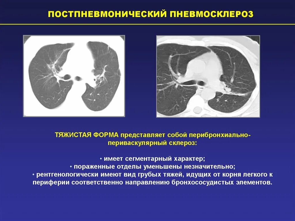 Тяжистый пневмофиброз легких кт. Пневмосклероз легких кт. Постпневмонический пневмосклероз. Постпневмонический фиброз на кт. Диффузные изменения в легких