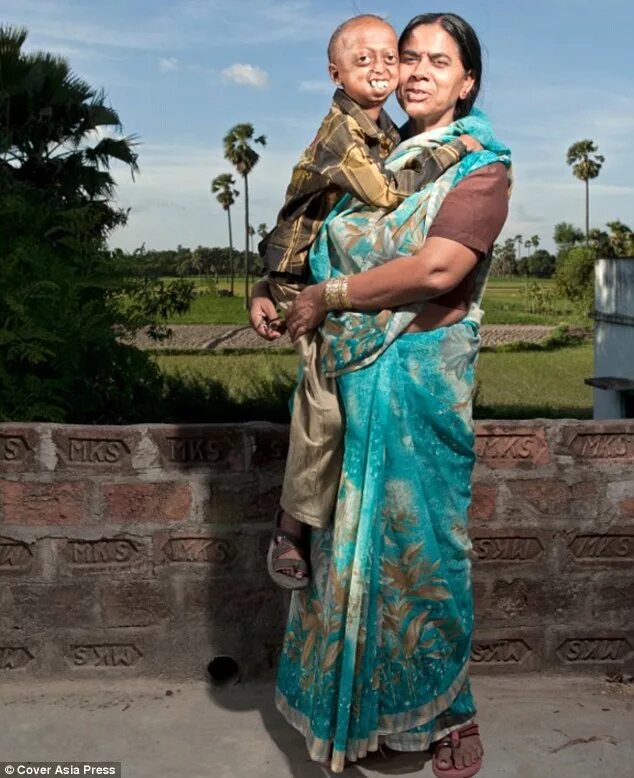 File:Progeria.png - Wikipedia