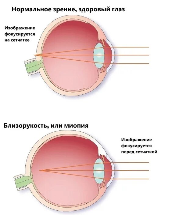 У близоруких людей изображение фокусируется перед сетчаткой. Myopia. Myopia Eyes. Myopia -50. Extreme myopia.