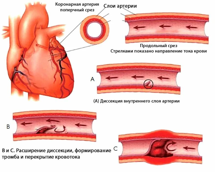 Ишемия крови