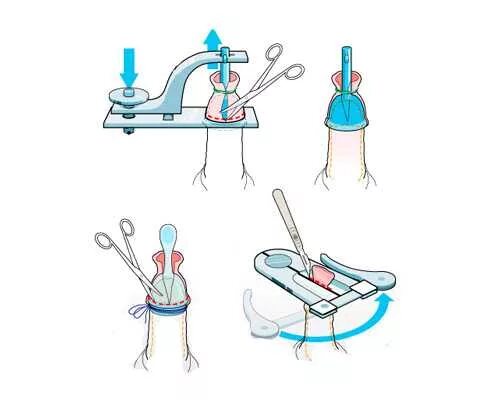 Что делать если головка не закрывается. Обрезание у мальчика схема. Схема обрезания крайней плоти. Обрезание схема операции.