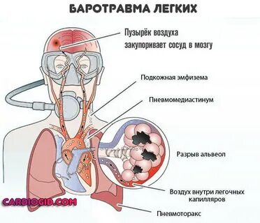 Что такое баротравма